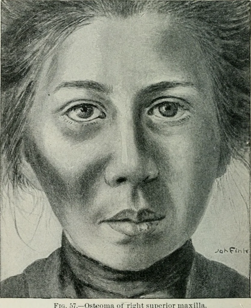 An illustration from Atlas and text-book of dentistry including diseases of the mouth / by Gustav Preiswerk. Edited by George W. Warren., 1906, leaf 196