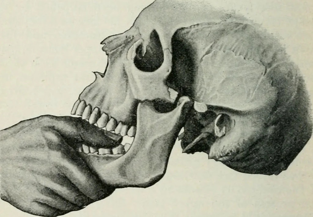An illustration from Atlas and text-book of dentistry including diseases of the mouth / by Gustav Preiswerk. Edited by George W. Warren., 1906, leaf 212