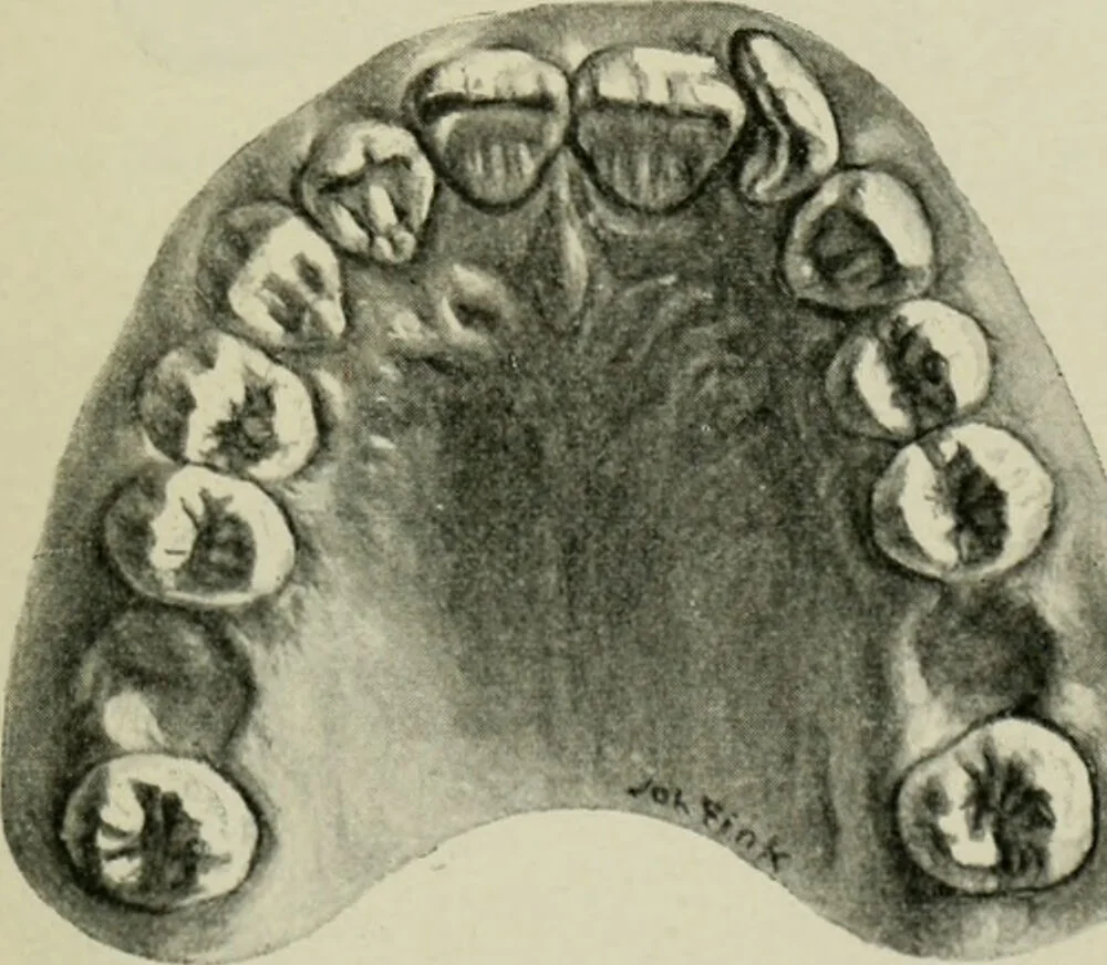 An illustration from Atlas and text-book of dentistry including diseases of the mouth / by Gustav Preiswerk. Edited by George W. Warren., 1906, leaf 239