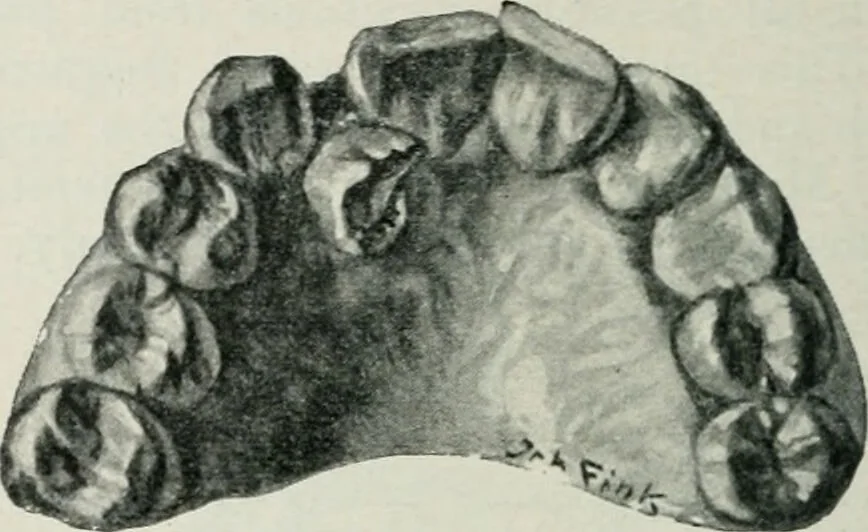 An illustration from Atlas and text-book of dentistry including diseases of the mouth / by Gustav Preiswerk. Edited by George W. Warren., 1906, leaf 240