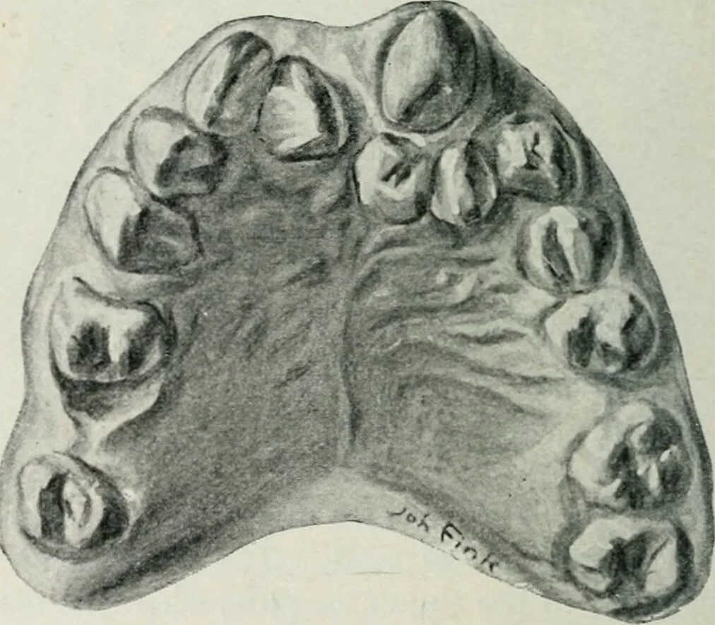 An illustration from Atlas and text-book of dentistry including diseases of the mouth / by Gustav Preiswerk. Edited by George W. Warren., 1906, leaf 240