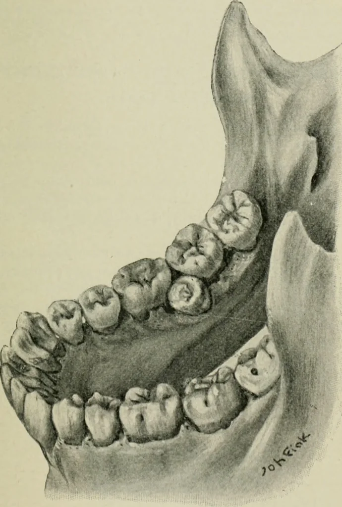 An illustration from Atlas and text-book of dentistry including diseases of the mouth / by Gustav Preiswerk. Edited by George W. Warren., 1906, leaf 241