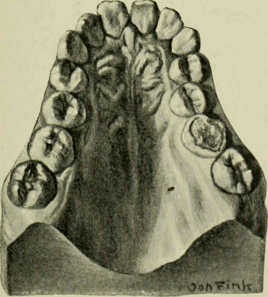 An illustration from Atlas and text-book of dentistry including diseases of the mouth / by Gustav Preiswerk. Edited by George W. Warren., 1906, leaf 247