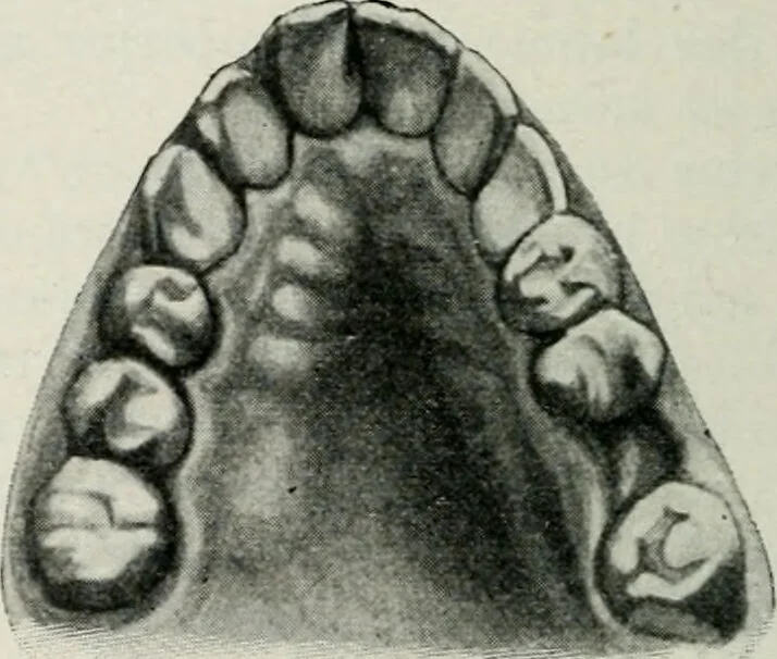 An illustration from Atlas and text-book of dentistry including diseases of the mouth / by Gustav Preiswerk. Edited by George W. Warren., 1906, leaf 252