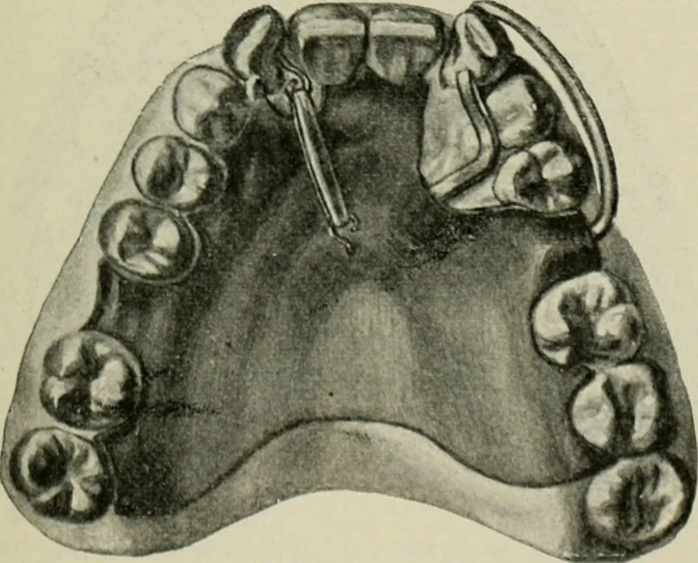 An illustration from Atlas and text-book of dentistry including diseases of the mouth / by Gustav Preiswerk. Edited by George W. Warren., 1906, leaf 253