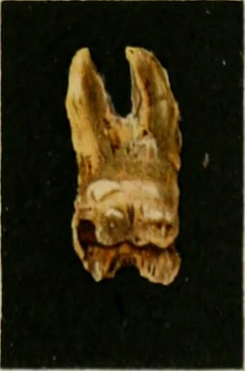 An illustration from Atlas and text-book of dentistry including diseases of the mouth / by Gustav Preiswerk. Edited by George W. Warren., 1906, leaf 263