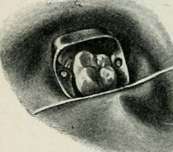 An illustration from Atlas and text-book of dentistry including diseases of the mouth / by Gustav Preiswerk. Edited by George W. Warren., 1906, leaf 310