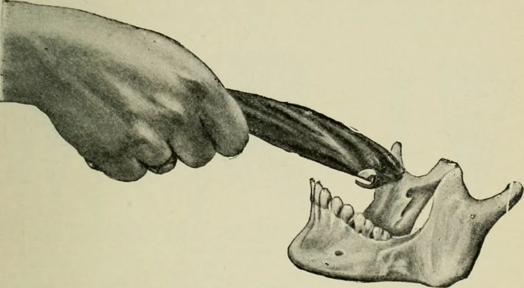 An illustration from Atlas and text-book of dentistry including diseases of the mouth / by Gustav Preiswerk. Edited by George W. Warren., 1906, leaf 311