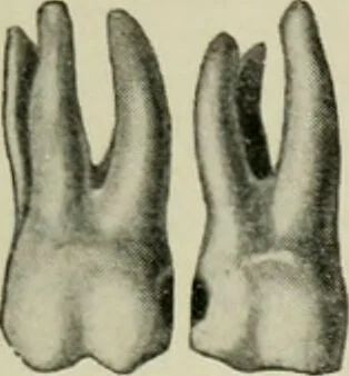An illustration from Atlas and text-book of dentistry including diseases of the mouth / by Gustav Preiswerk. Edited by George W. Warren., 1906, leaf 315