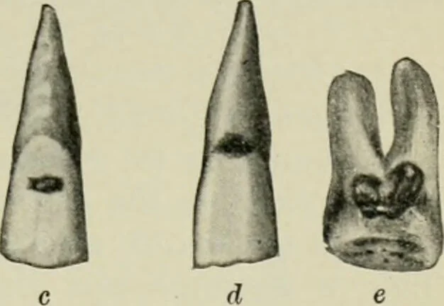 An illustration from Atlas and text-book of dentistry including diseases of the mouth / by Gustav Preiswerk. Edited by George W. Warren., 1906, leaf 315
