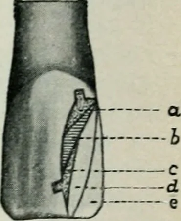 An illustration from Atlas and text-book of dentistry including diseases of the mouth / by Gustav Preiswerk. Edited by George W. Warren., 1906, leaf 326