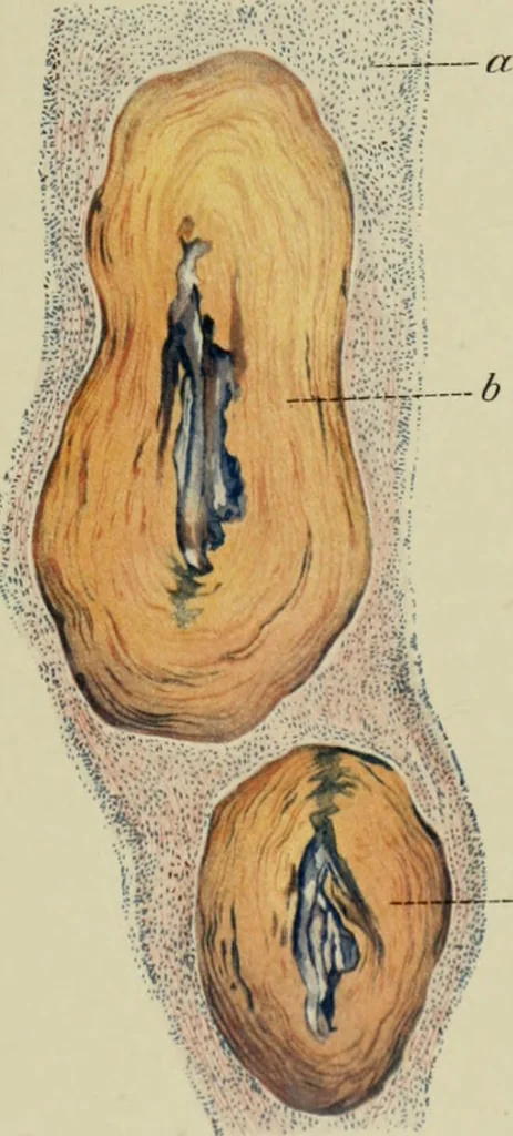 An illustration from Atlas and text-book of dentistry including diseases of the mouth / by Gustav Preiswerk. Edited by George W. Warren., 1906, leaf 369