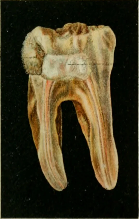 An illustration from Atlas and text-book of dentistry including diseases of the mouth / by Gustav Preiswerk. Edited by George W. Warren., 1906, leaf 385