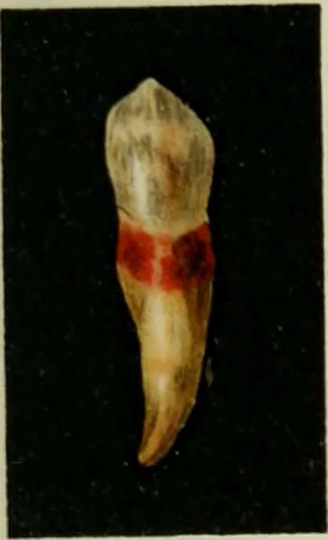 An illustration from Atlas and text-book of dentistry including diseases of the mouth / by Gustav Preiswerk. Edited by George W. Warren., 1906, leaf 391