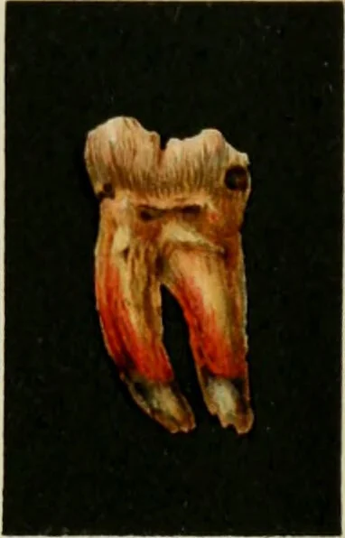 An illustration from Atlas and text-book of dentistry including diseases of the mouth / by Gustav Preiswerk. Edited by George W. Warren., 1906, leaf 395