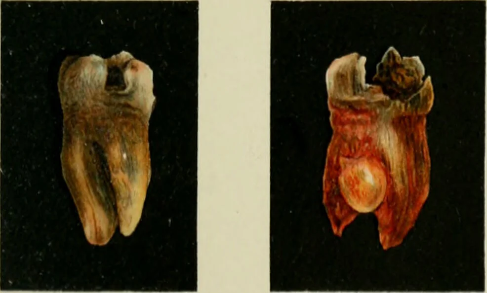 An illustration from Atlas and text-book of dentistry including diseases of the mouth / by Gustav Preiswerk. Edited by George W. Warren., 1906, leaf 395