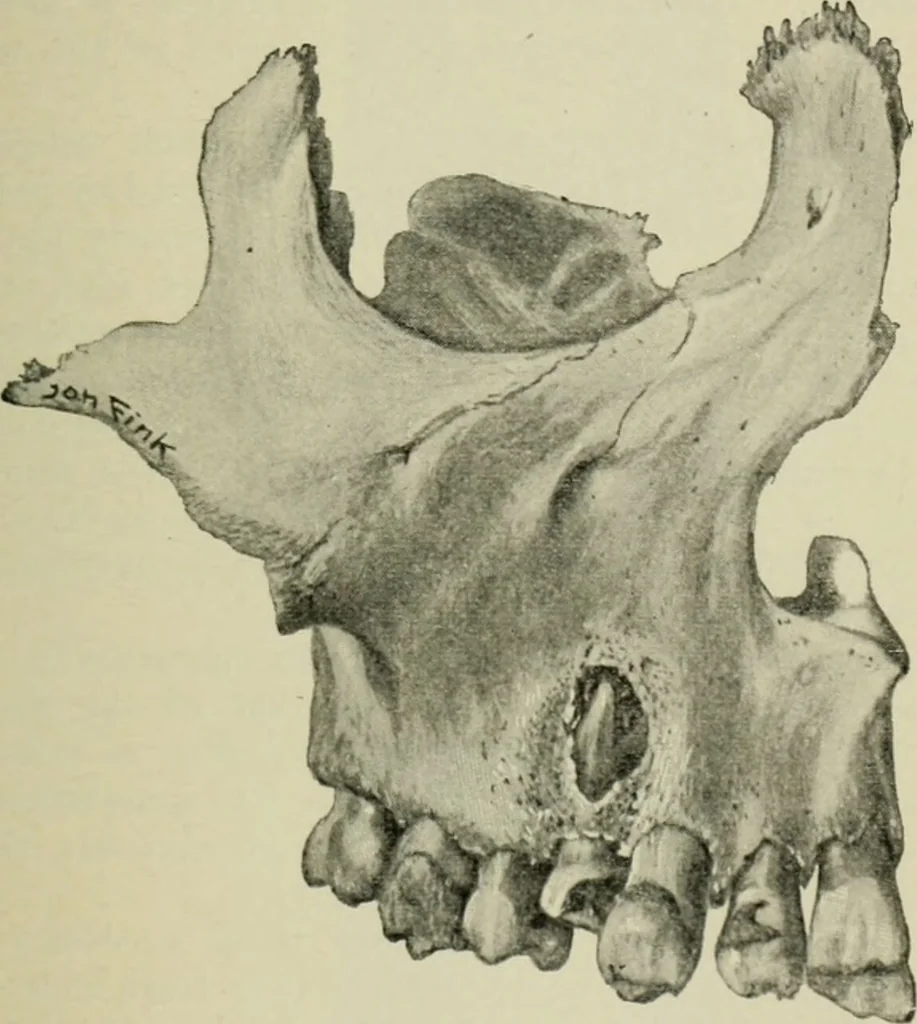 An illustration from Atlas and text-book of dentistry including diseases of the mouth / by Gustav Preiswerk. Edited by George W. Warren., 1906, leaf 407