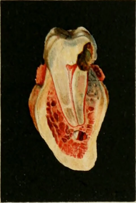 An illustration from Atlas and text-book of dentistry including diseases of the mouth / by Gustav Preiswerk. Edited by George W. Warren., 1906, leaf 409