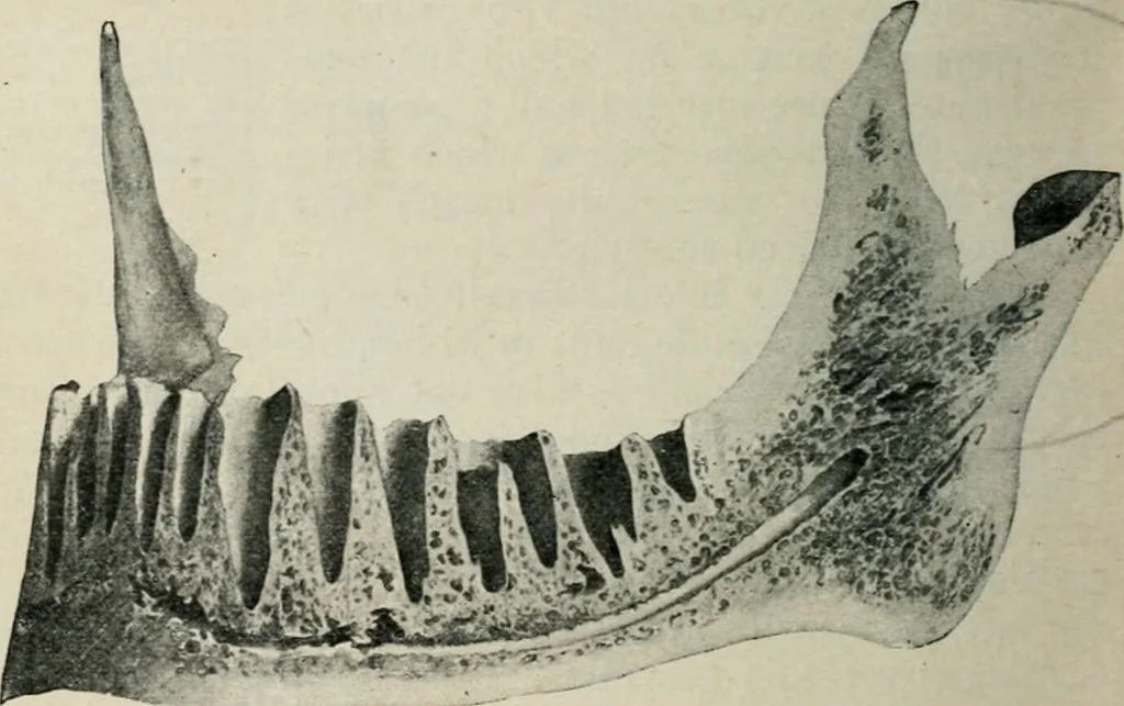 An illustration from Atlas and text-book of dentistry including diseases of the mouth / by Gustav Preiswerk. Edited by George W. Warren., 1906, leaf 60