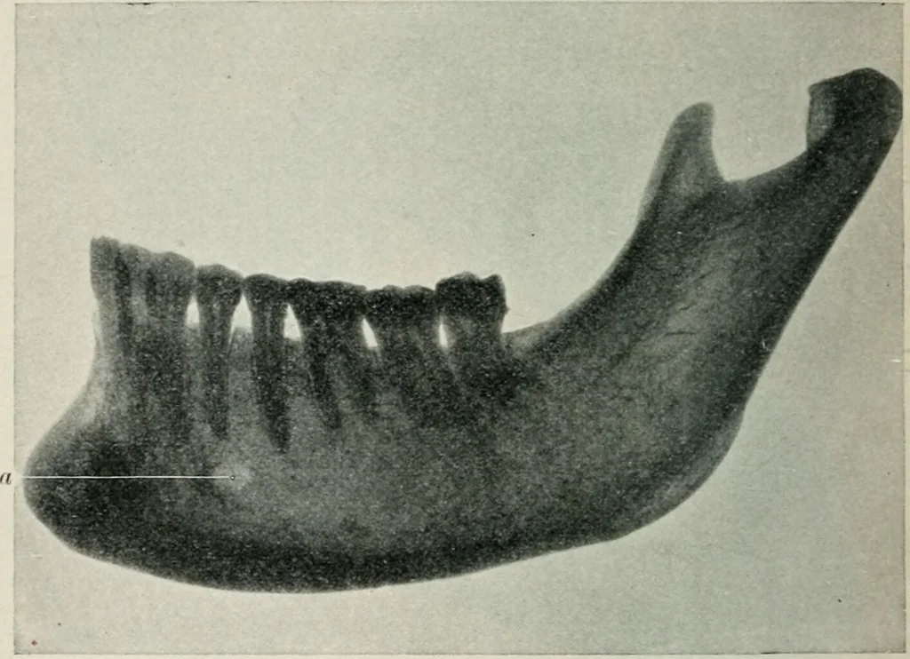 An illustration from Atlas and text-book of dentistry including diseases of the mouth / by Gustav Preiswerk. Edited by George W. Warren., 1906, leaf 66