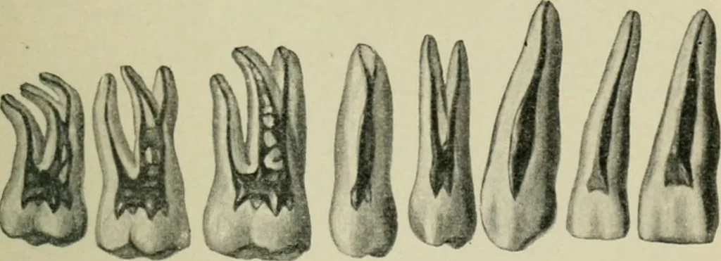 An illustration from Atlas and text-book of dentistry including diseases of the mouth / by Gustav Preiswerk. Edited by George W. Warren., 1906, leaf 71