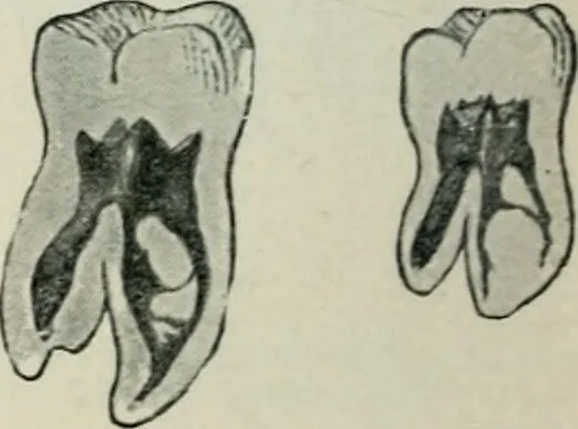 An illustration from Atlas and text-book of dentistry including diseases of the mouth / by Gustav Preiswerk. Edited by George W. Warren., 1906, leaf 72