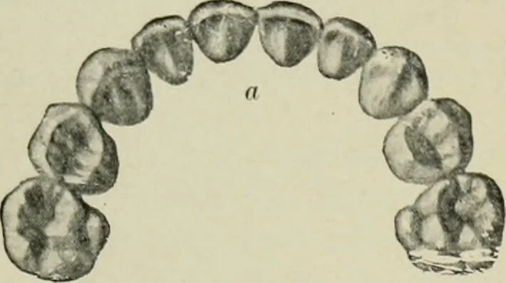 An illustration from Atlas and text-book of dentistry including diseases of the mouth / by Gustav Preiswerk. Edited by George W. Warren., 1906, leaf 93