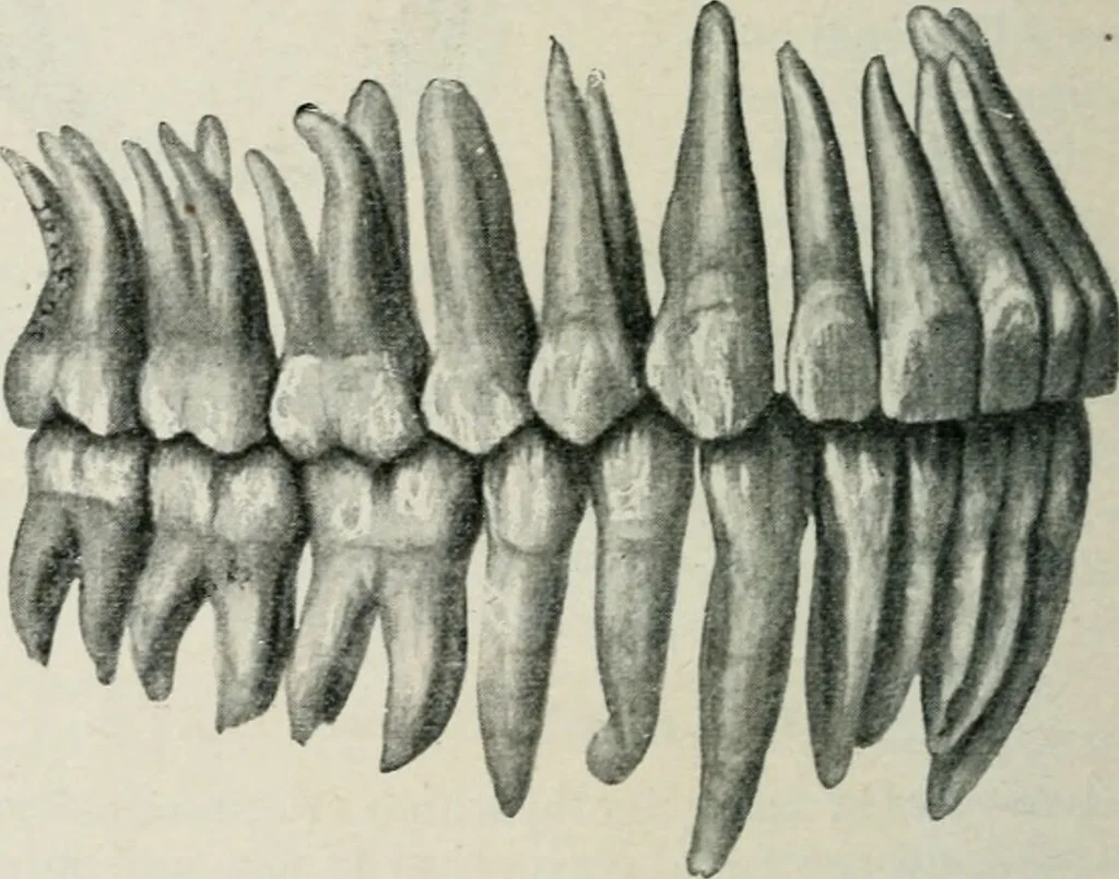 An illustration from Atlas and text-book of dentistry including diseases of the mouth / by Gustav Preiswerk. Edited by George W. Warren., 1906, leaf 94