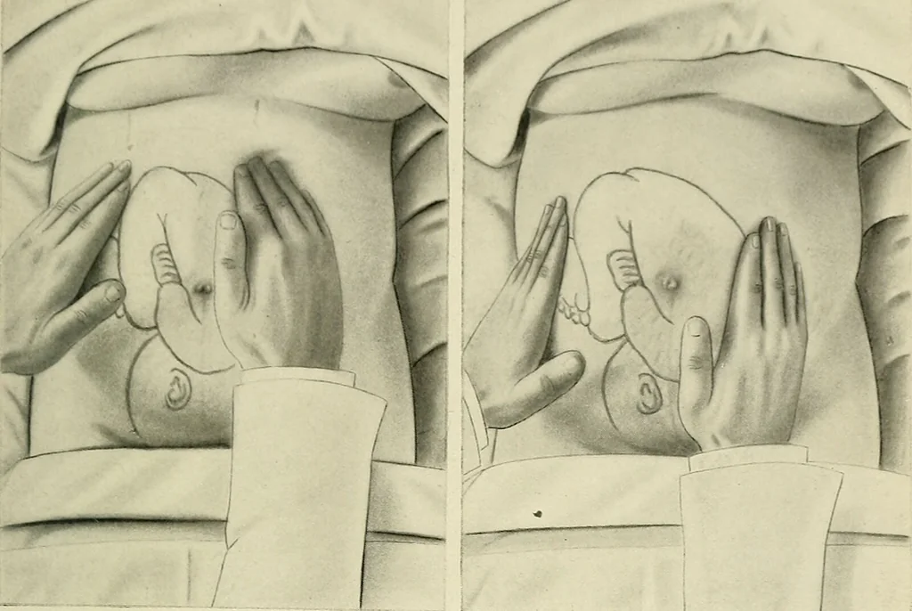 An illustration from Obstetrics : a text-book for the use of students and practitioners / by J. Whitridge Williams ... with eight coloured plates and six hundred and thirty illustrations in the text., 1903, leaf 273