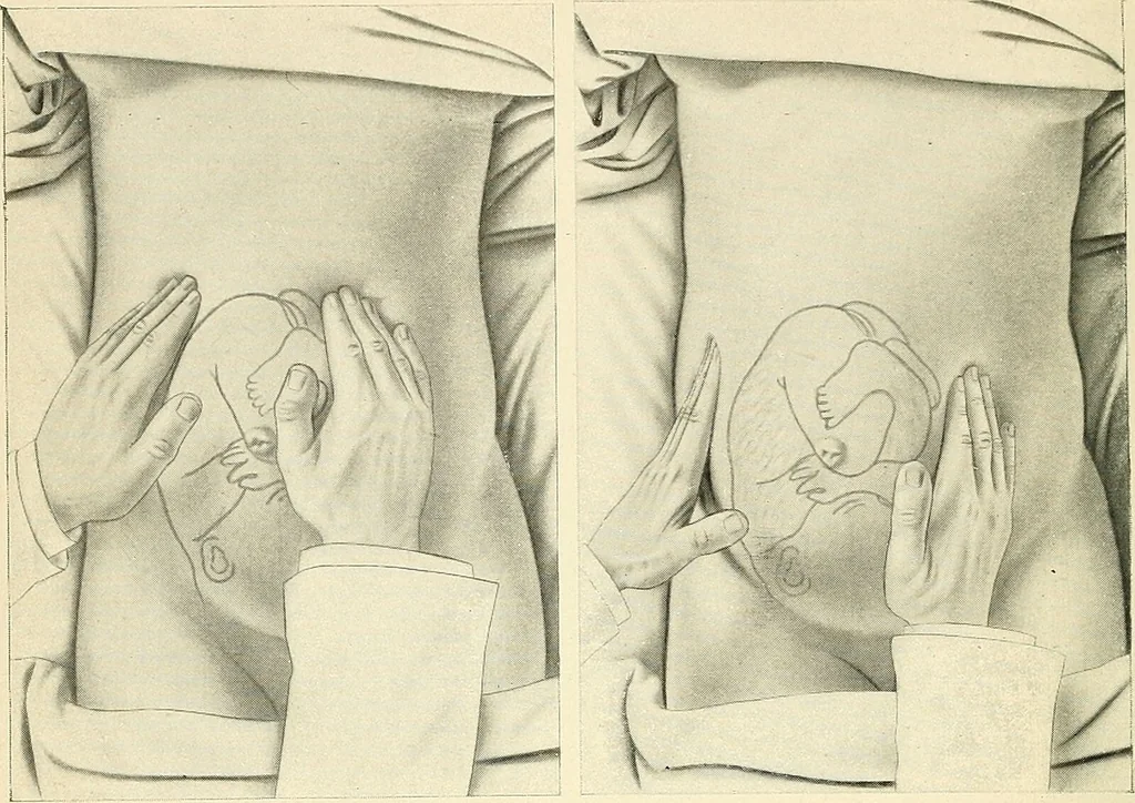 An illustration from Obstetrics : a text-book for the use of students and practitioners / by J. Whitridge Williams ... with eight coloured plates and six hundred and thirty illustrations in the text., 1903, leaf 286