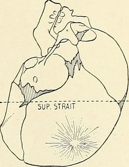 An illustration from Obstetrics : a text-book for the use of students and practitioners / by J. Whitridge Williams ... with eight coloured plates and six hundred and thirty illustrations in the text., 1903, leaf 302