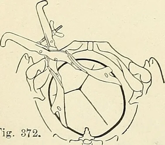 An illustration from Obstetrics : a text-book for the use of students and practitioners / by J. Whitridge Williams ... with eight coloured plates and six hundred and thirty illustrations in the text., 1903, leaf 424