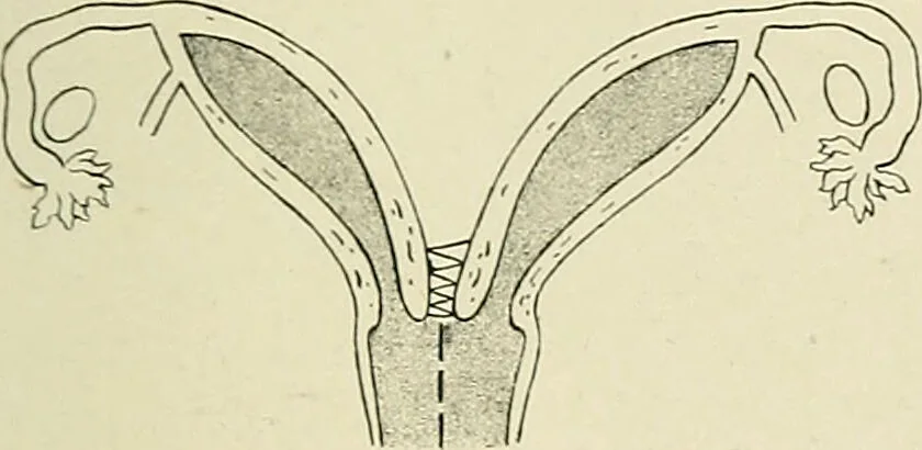 An illustration from Obstetrics : a text-book for the use of students and practitioners / by J. Whitridge Williams ... with eight coloured plates and six hundred and thirty illustrations in the text., 1903, leaf 521