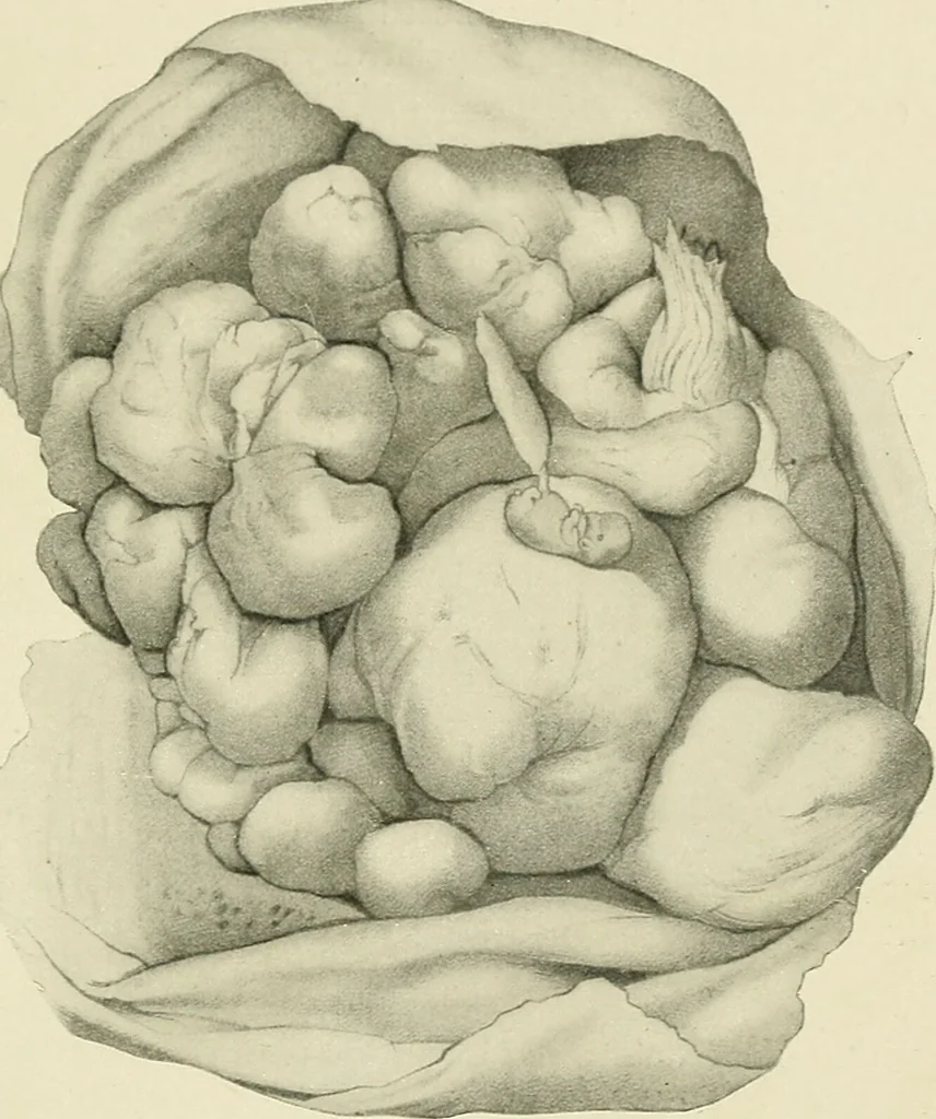 An illustration from Obstetrics : a text-book for the use of students and practitioners / by J. Whitridge Williams ... with eight coloured plates and six hundred and thirty illustrations in the text., 1903, leaf 579
