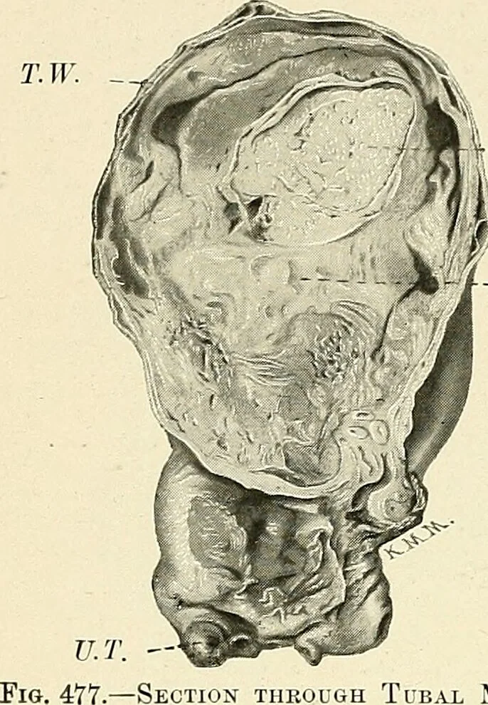 An illustration from Obstetrics : a text-book for the use of students and practitioners / by J. Whitridge Williams ... with eight coloured plates and six hundred and thirty illustrations in the text., 1903, leaf 596