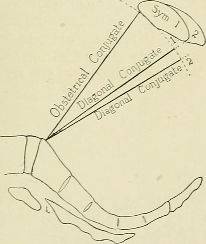 An illustration from Obstetrics : a text-book for the use of students and practitioners / by J. Whitridge Williams ... with eight coloured plates and six hundred and thirty illustrations in the text., 1903, leaf 643