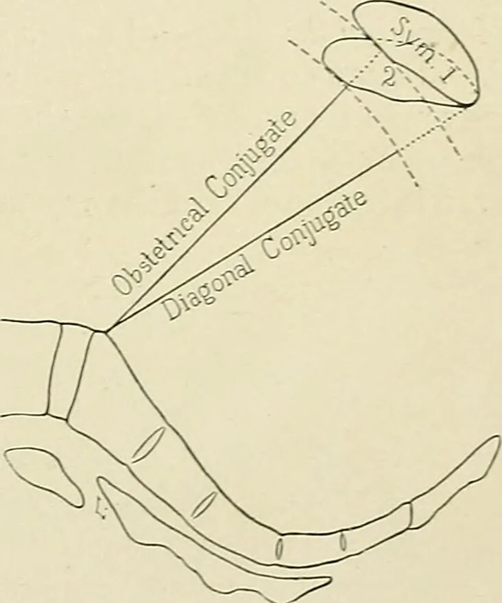 An illustration from Obstetrics : a text-book for the use of students and practitioners / by J. Whitridge Williams ... with eight coloured plates and six hundred and thirty illustrations in the text., 1903, leaf 643