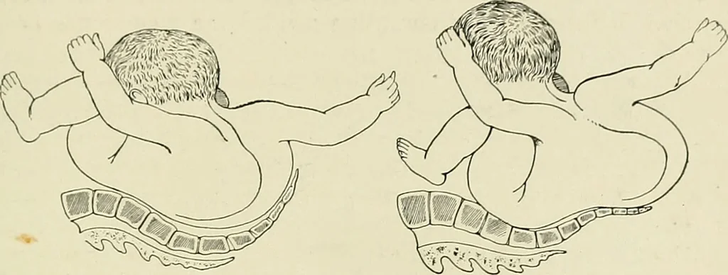 An illustration from Obstetrics : a text-book for the use of students and practitioners / by J. Whitridge Williams ... with eight coloured plates and six hundred and thirty illustrations in the text., 1903, leaf 745
