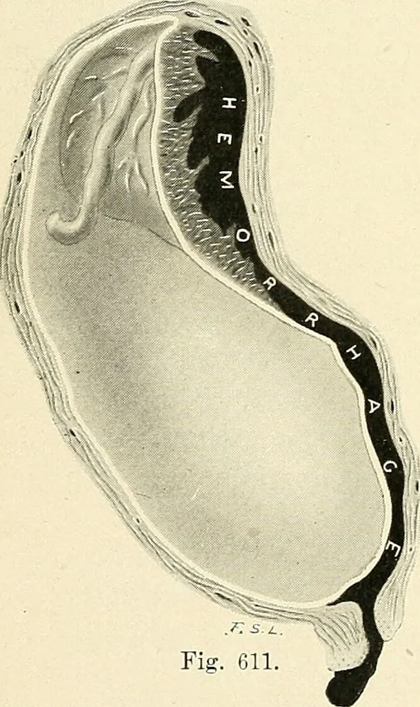 An illustration from Obstetrics : a text-book for the use of students and practitioners / by J. Whitridge Williams ... with eight coloured plates and six hundred and thirty illustrations in the text., 1903, leaf 770