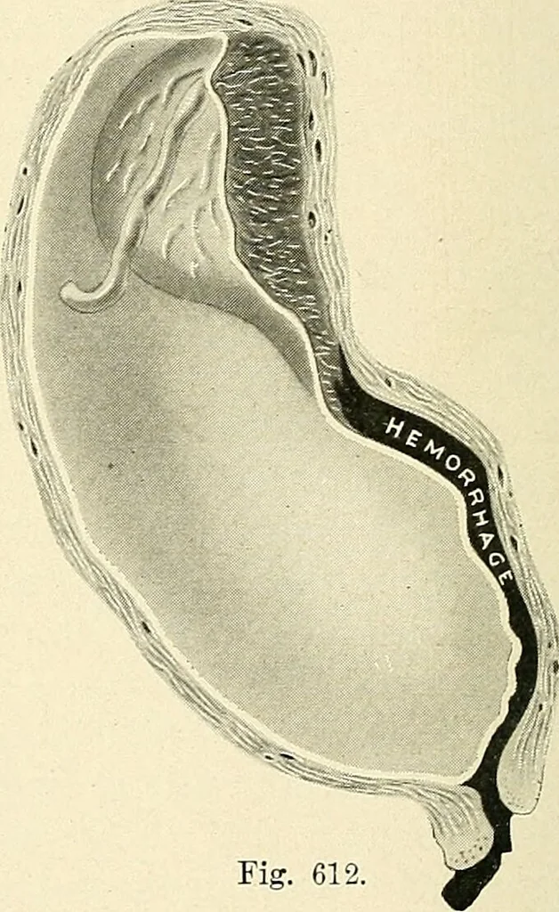 An illustration from Obstetrics : a text-book for the use of students and practitioners / by J. Whitridge Williams ... with eight coloured plates and six hundred and thirty illustrations in the text., 1903, leaf 770