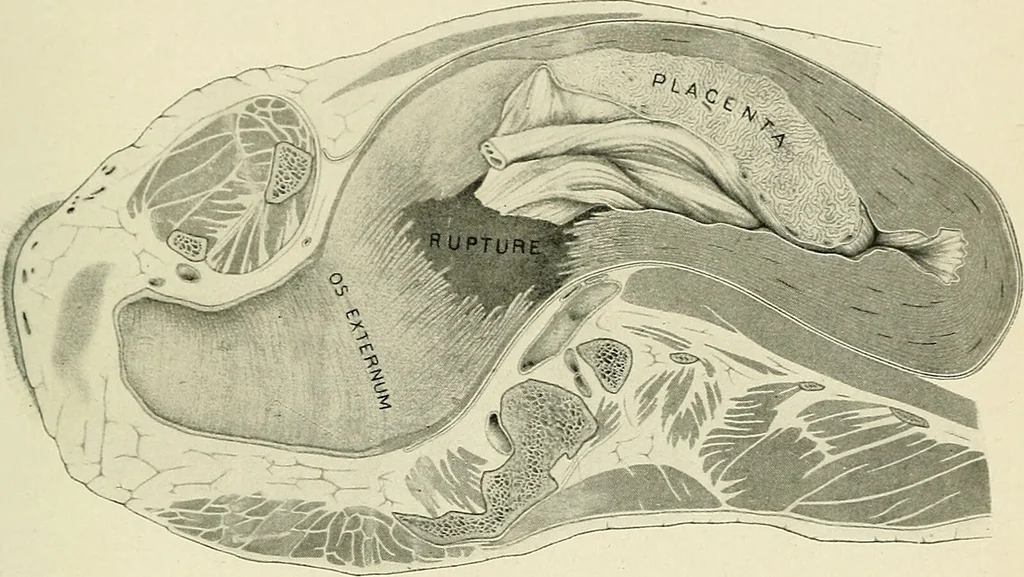 An illustration from Obstetrics : a text-book for the use of students and practitioners / by J. Whitridge Williams ... with eight coloured plates and six hundred and thirty illustrations in the text., 1903, leaf 797