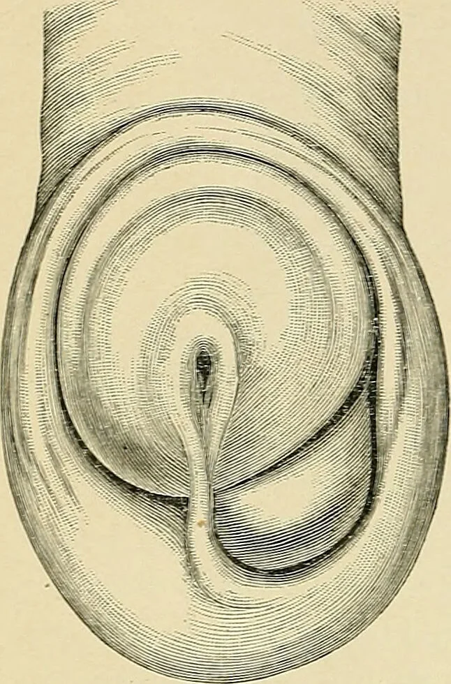 An illustration from A practical treatise on genito-urinary and venereal diseases and syphilis / By Robert W. Taylor., 1904, leaf 142