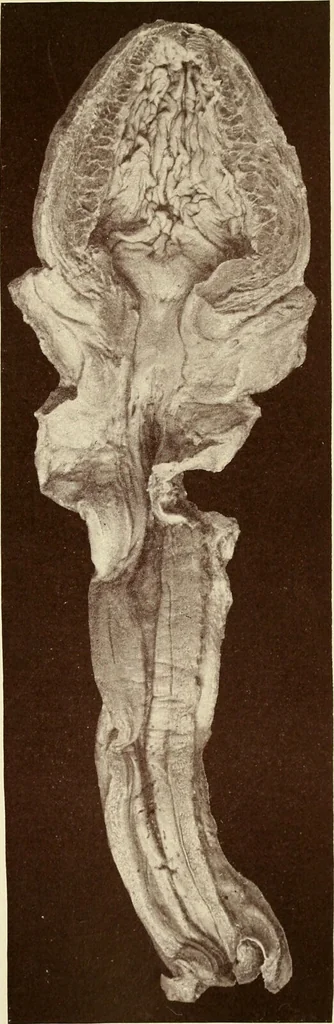 An illustration from A practical treatise on genito-urinary and venereal diseases and syphilis / By Robert W. Taylor., 1904, leaf 187