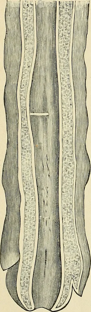 An illustration from A practical treatise on genito-urinary and venereal diseases and syphilis / By Robert W. Taylor., 1904, leaf 212