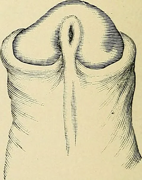 An illustration from A practical treatise on genito-urinary and venereal diseases and syphilis / By Robert W. Taylor., 1904, leaf 238