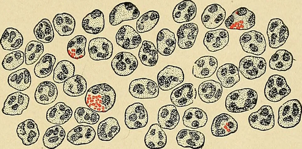 An illustration from A practical treatise on genito-urinary and venereal diseases and syphilis / By Robert W. Taylor., 1904, leaf 31