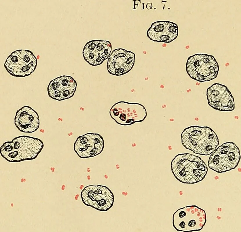 An illustration from A practical treatise on genito-urinary and venereal diseases and syphilis / By Robert W. Taylor., 1904, leaf 32