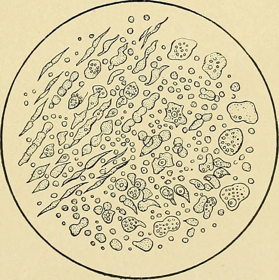 An illustration from A practical treatise on genito-urinary and venereal diseases and syphilis / By Robert W. Taylor., 1904, leaf 37