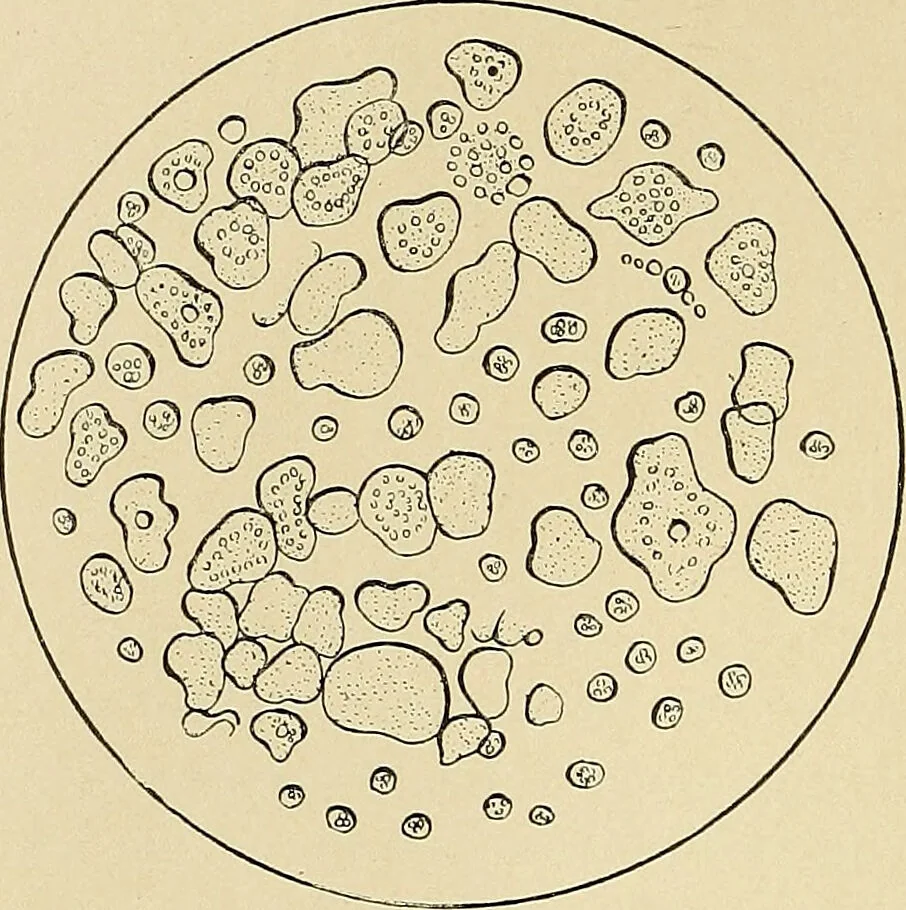 An illustration from A practical treatise on genito-urinary and venereal diseases and syphilis / By Robert W. Taylor., 1904, leaf 38