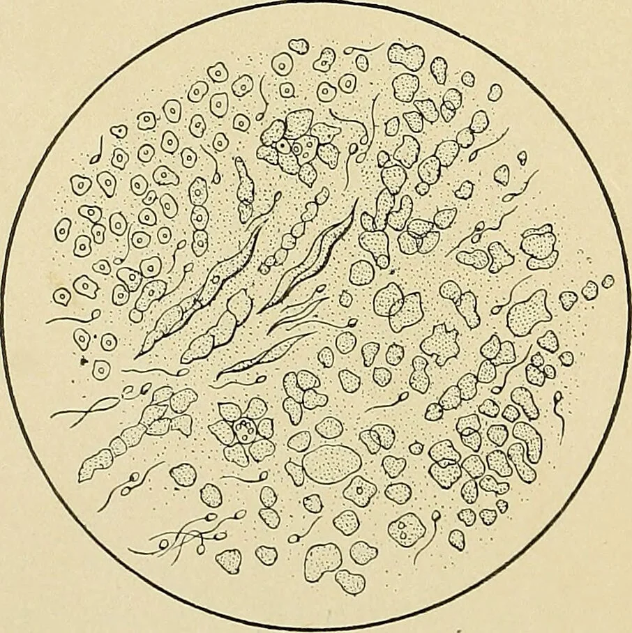 An illustration from A practical treatise on genito-urinary and venereal diseases and syphilis / By Robert W. Taylor., 1904, leaf 38